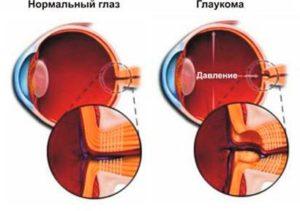 нагрузка на глаз - глаукома