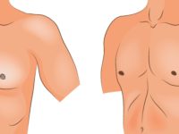 Ложная гинекомастия — как избавиться от лишнего жира на груди